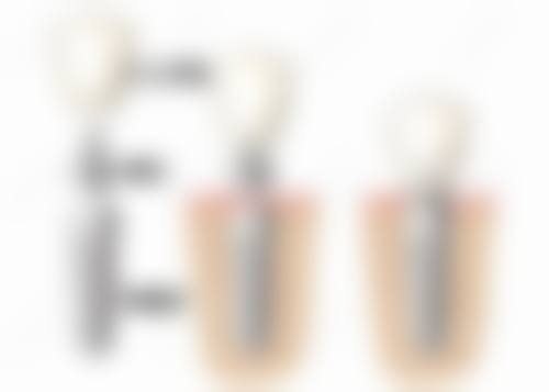 非常后悔做了种植牙，了解正规医院的优势