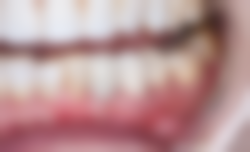 新疆镶牙医生24小时在线咨询，助你了解镶牙价格、医院及医生信息！ 