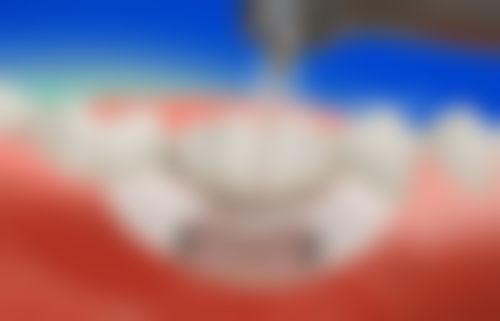 洗牙所需时间的决定因素