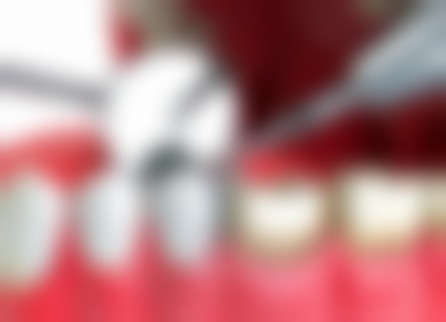 老年人种植牙的优势大揭秘