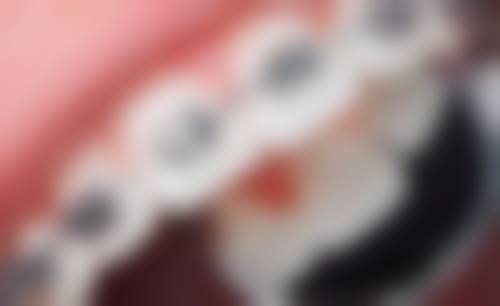 实惠价格让牙齿矫正不踩坑