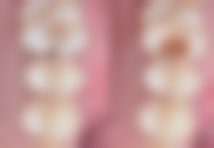 全瓷牙冠硬度在临床应用中的表现：实际成效全呈现