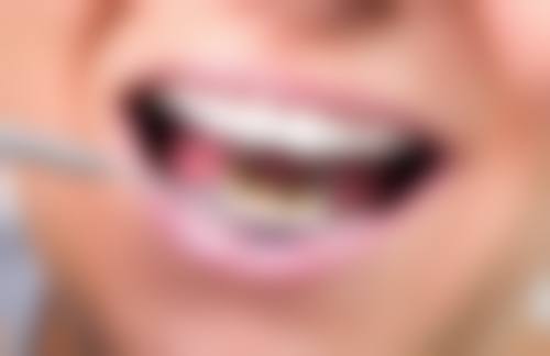 单冠烤瓷牙：独立修复的优势与局限