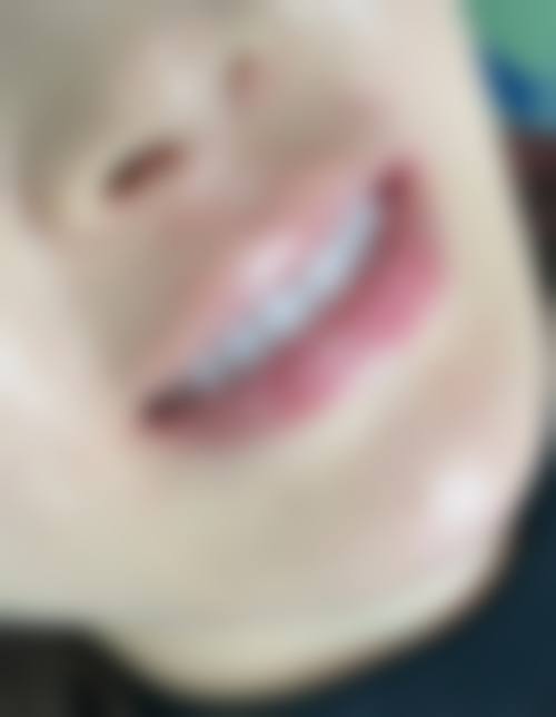 4岁小孩根管治疗成效显著，家长好评如潮