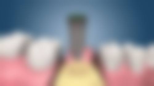 泽康:德国美学,氧化锆全瓷牙的耐用之选