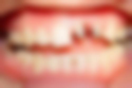 {海南种植牙医院24小时在线咨询！海口多家24小时牙科可选，国雅种牙矫正实惠又靠谱 