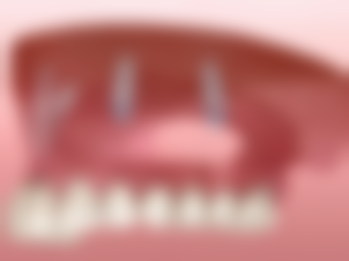 根尖周炎引发松动,治疗有妙招