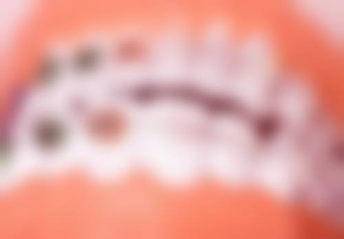 特殊人群在口腔诊所洗牙的注意事项