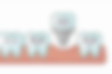 牙齿修复的常见问题