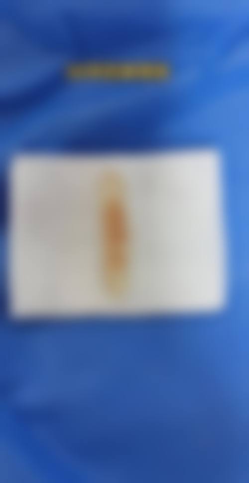 广州佳和医院血管瘤科口碑如何？