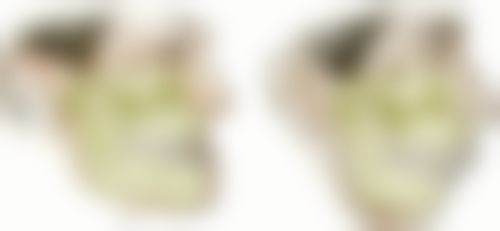 色素沉着型黑点,补牙必要性大剖析