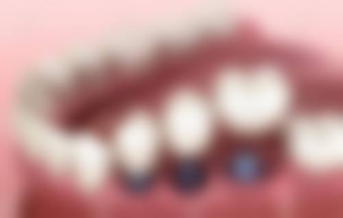 张家口镶牙医生24小时在线咨询！5家透明收费门诊，烤瓷牙599元起，还有多种优惠！ 