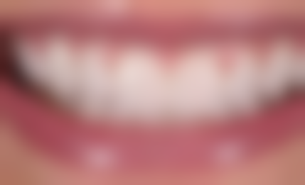 镶牙后注意事项