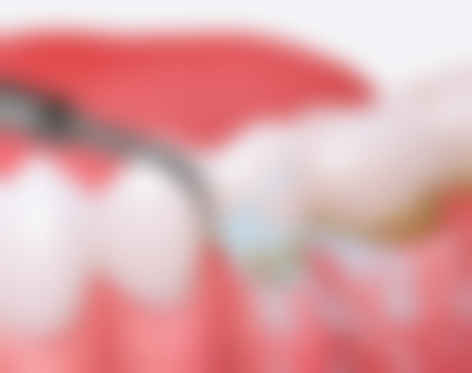 不同阶段龋齿黑点,补牙方案大不同