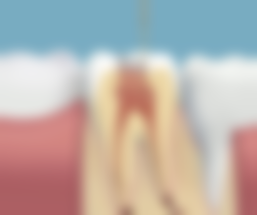 采用微创拔牙技术，实现快速拔牙