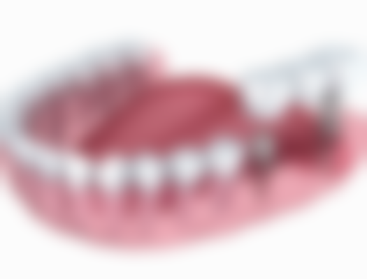 27岁矫正牙齿的注意事项:健康、美观、成效