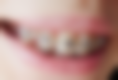 术后护理:保护根管治疗与补牙成效的关键