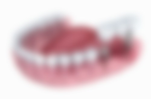 烤瓷牙与其他牙齿修复方式咀嚼功能的对比