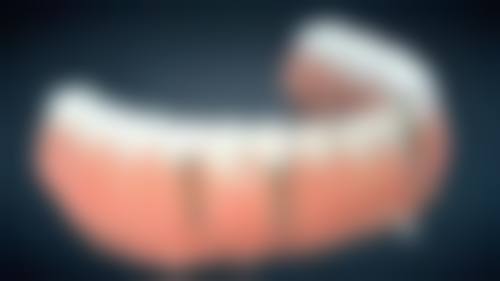 烤瓷牙材料对咀嚼功能修复的影响