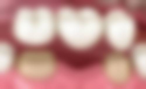 冷光美白：快速美白，应对轻度着色