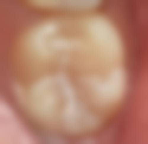 雅悦齿科其他项目价格