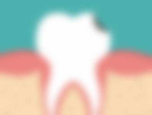 拔牙后饮食时间及注意事项