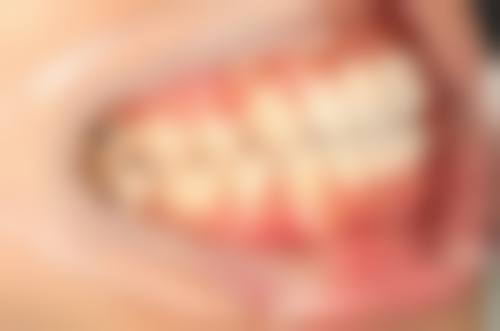 选择舌侧矫正机构的要点