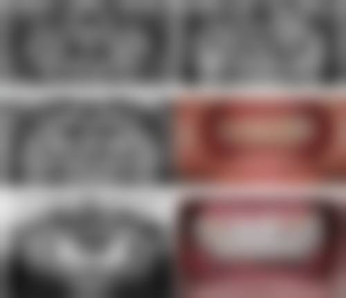 拔牙5年种牙：骨质好仍有机会