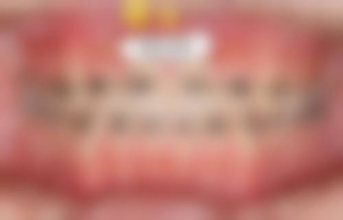 33岁矫正牙齿,如何选择合适的医院和医生?