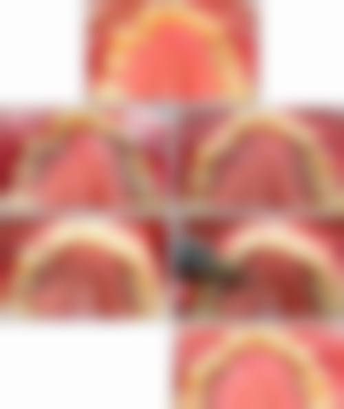 33岁矫正牙齿,矫正周期和成效如何?