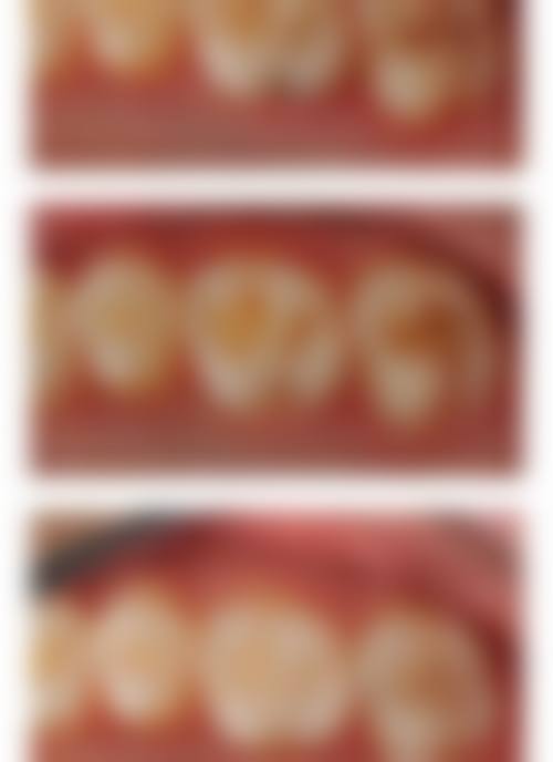 残髓炎导致的牙齿过敏