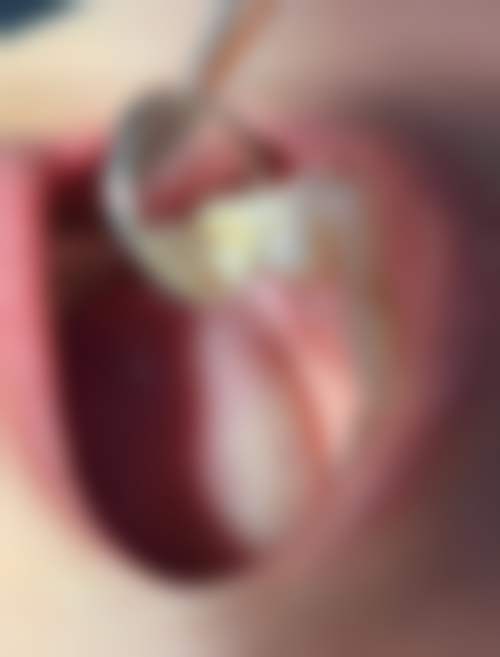 复合树脂：美观实用但也有短板