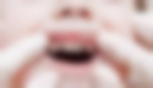 湖州复大中齿口腔诊所种植牙价格及优势