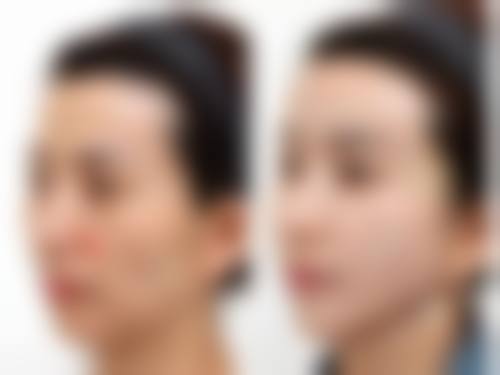 韩国Merry整形外科收费价格表/收费标准