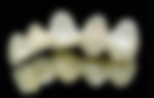 功能性矫治器：专精矫正的有效手段