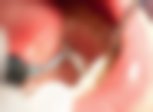 深圳格伦菲尔口腔牙齿矫正价格情况