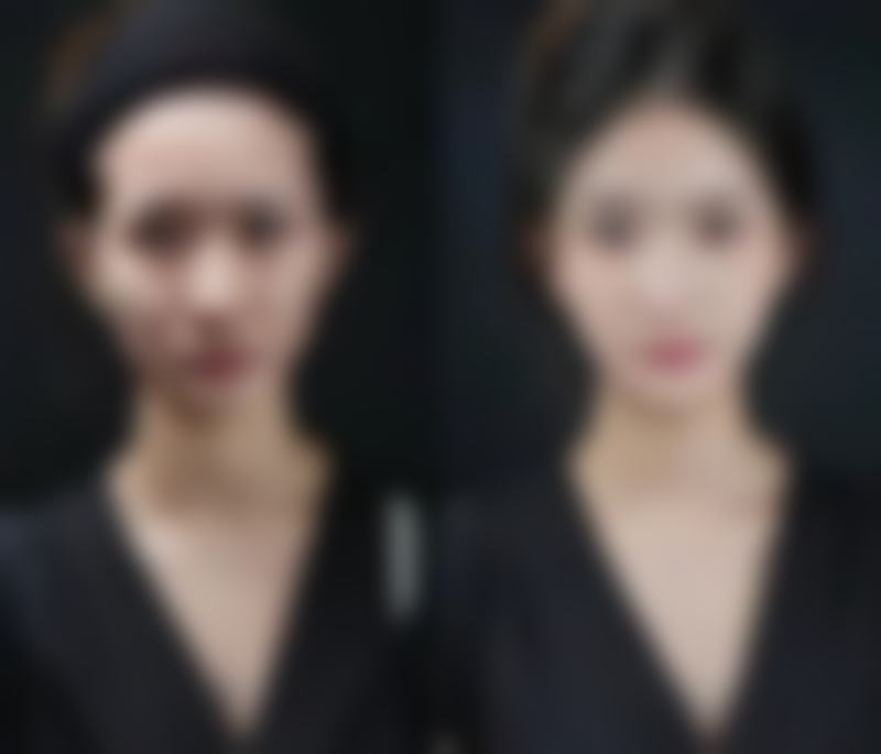 沈阳城本整形医院真实实例