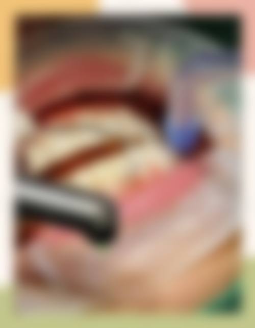 烤瓷牙做冷光美白的可行性分析