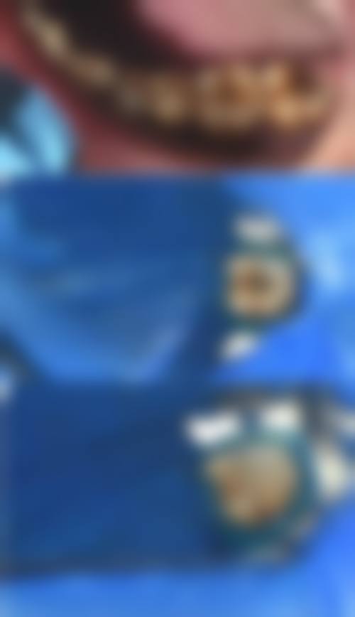 牙位差异：不同牙齿根管治疗时间大不同