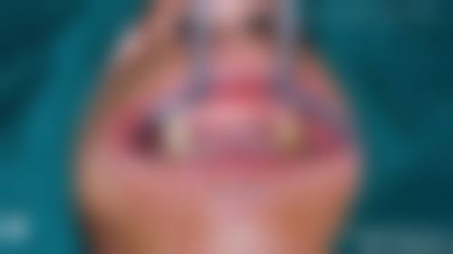 淄博张店区靠谱种植牙医院