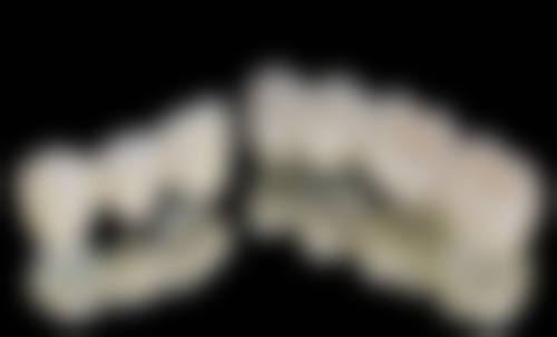 烤瓷牙治疗牙不齐的优势与风险