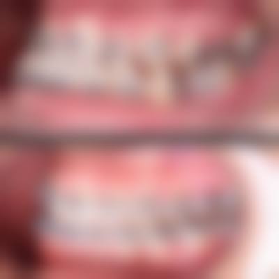 矫正地包天的注意事项