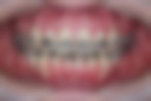 牙性反颌：15岁矫正的可行之路