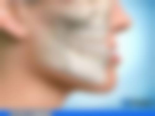 颌骨发育问题：先天不足造成骨性反颌