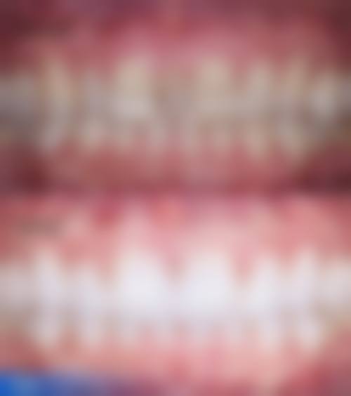 门牙修复选择：看三点就够了