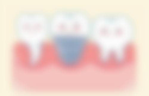 烤瓷牙与种植牙：使用寿命大比拼