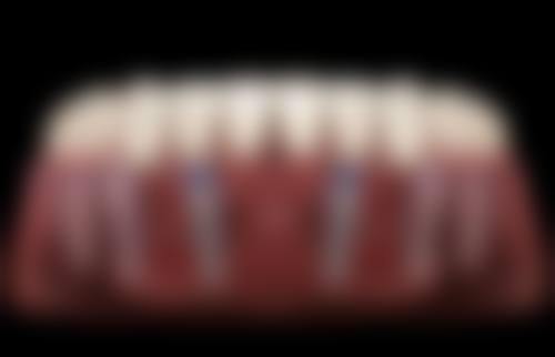 烤瓷牙与种植牙：适用人群大不同