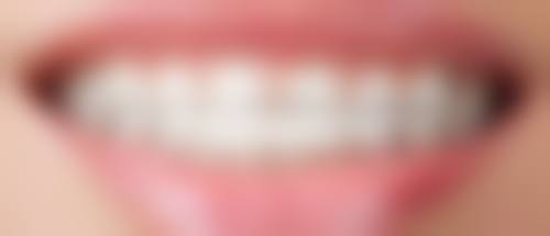 佩戴矫治器，科学矫正地包天