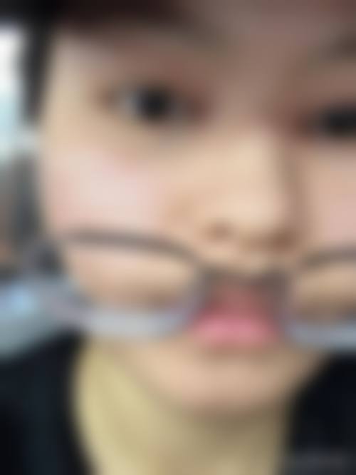 开眼角（眼角开大术）