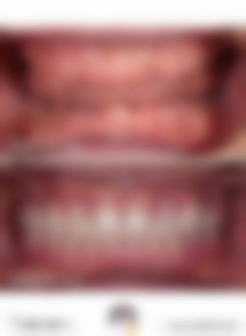 半口种牙收费情况